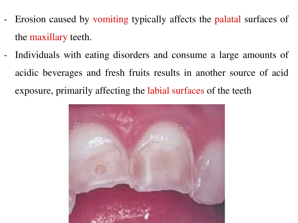 erosion caused by vomiting typically affects