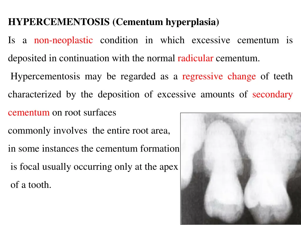 hypercementosis cementum hyperplasia