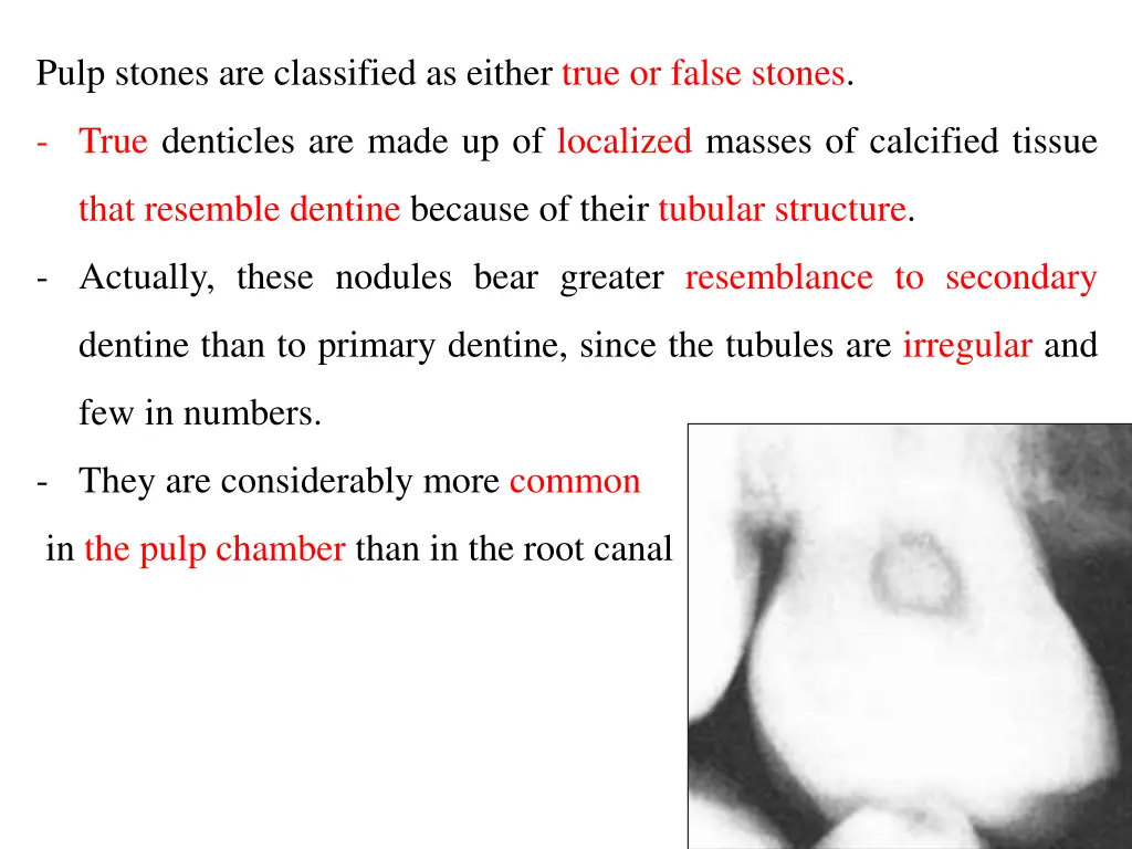 pulp stones are classified as either true