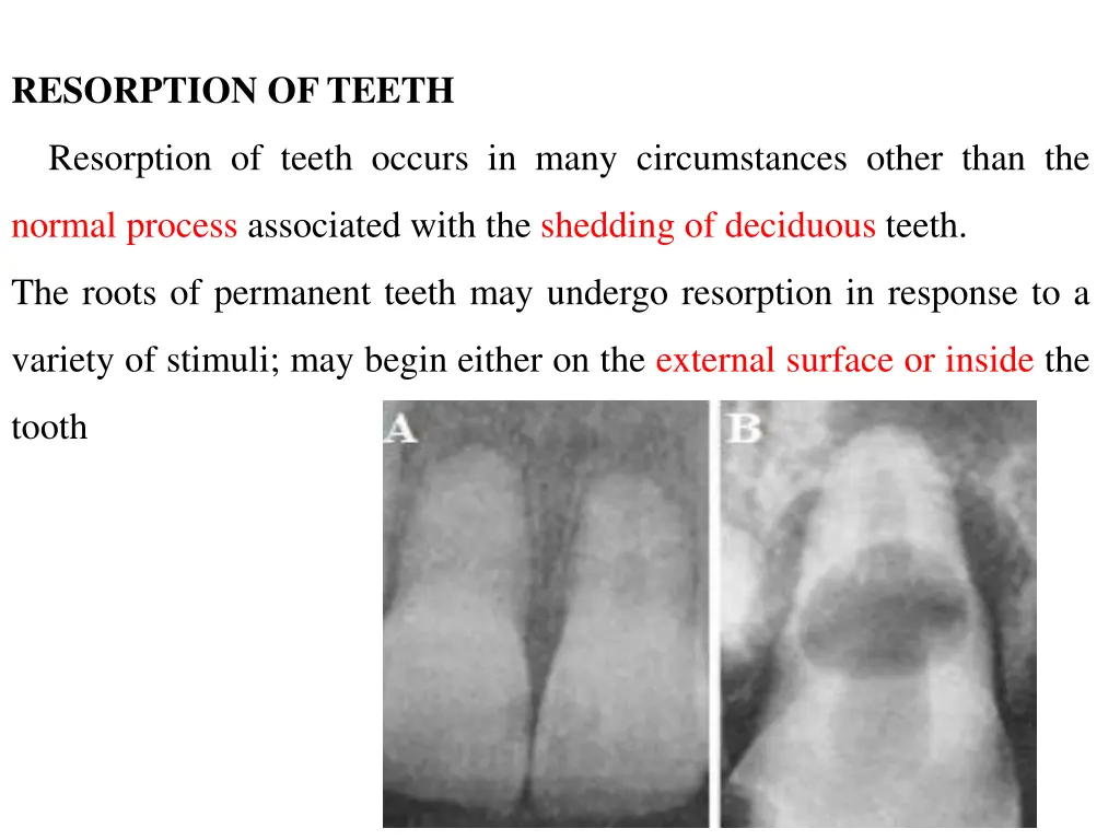 resorption of teeth