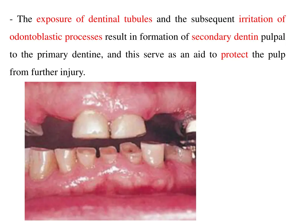 the exposure of dentinal tubules