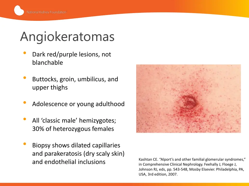angiokeratomas