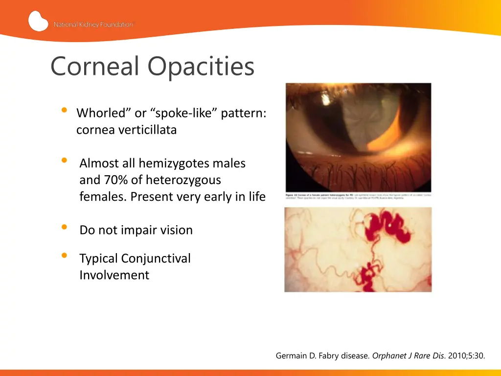 corneal opacities