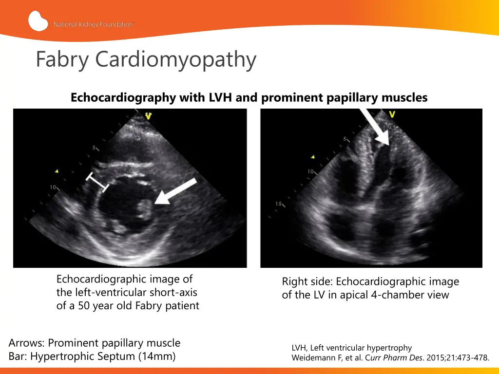 fabry cardiomyopathy