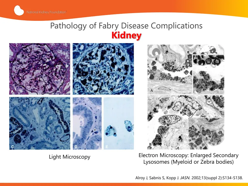 pathology of fabry disease complications kidney