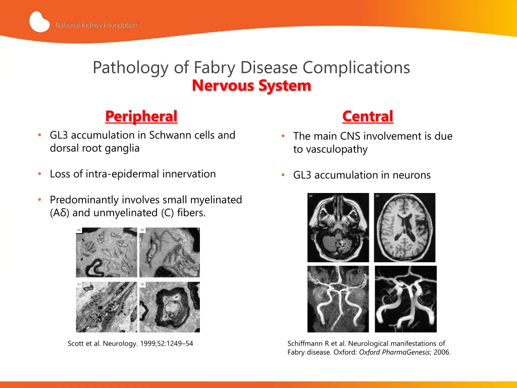 pathology of fabry disease complications nervous