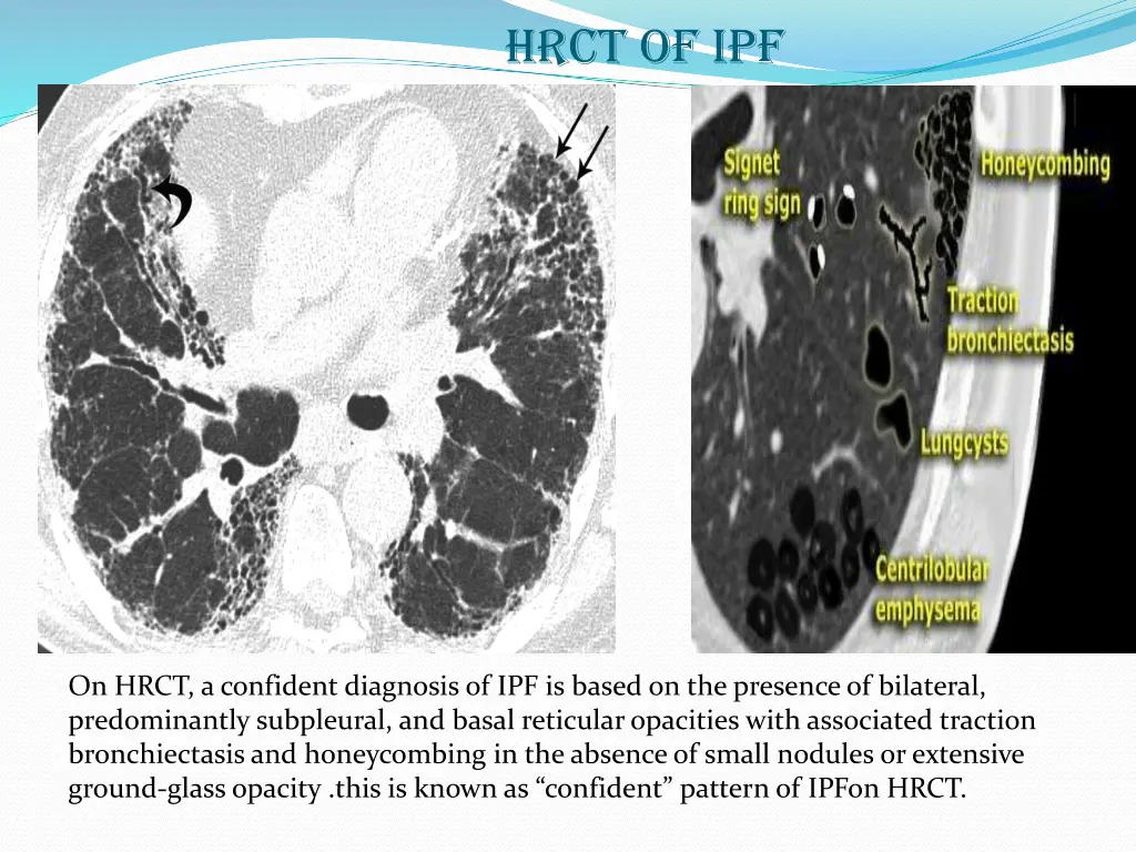 hrct of ipf