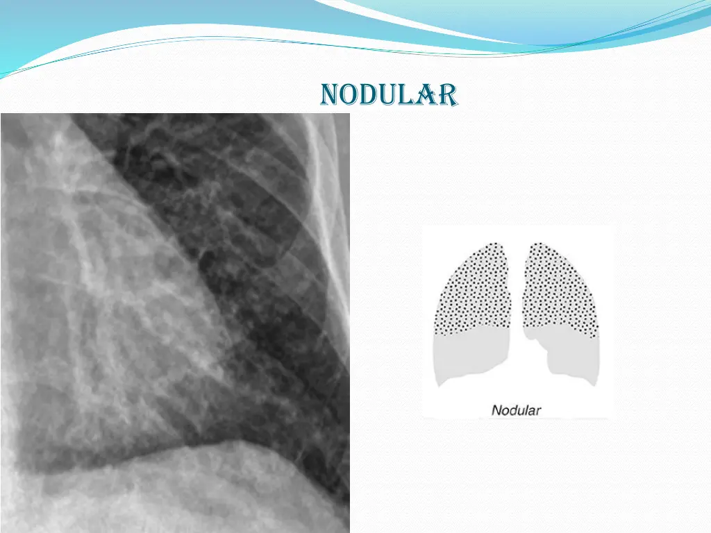 nodular