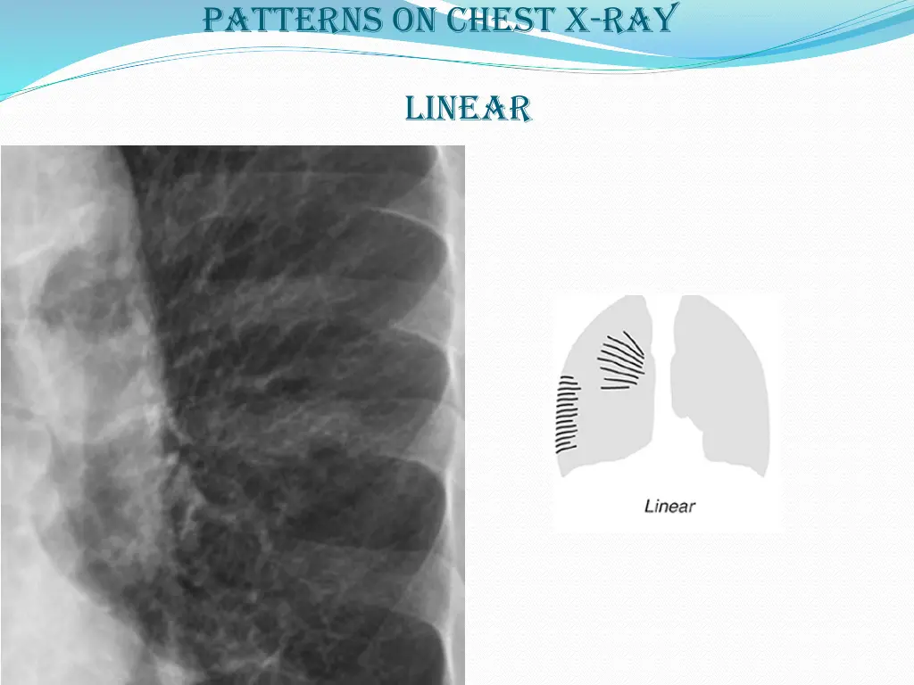 patterns on chest x ray