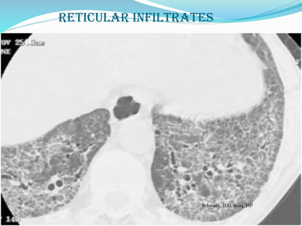 reticular infiltrates