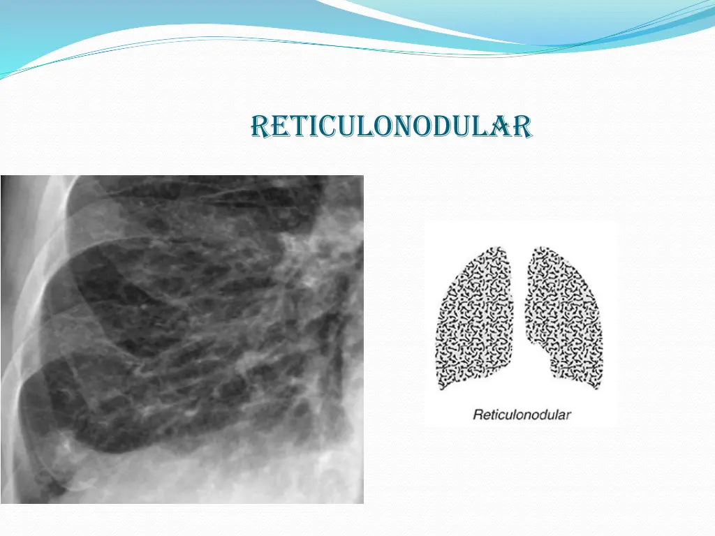 reticulonodular