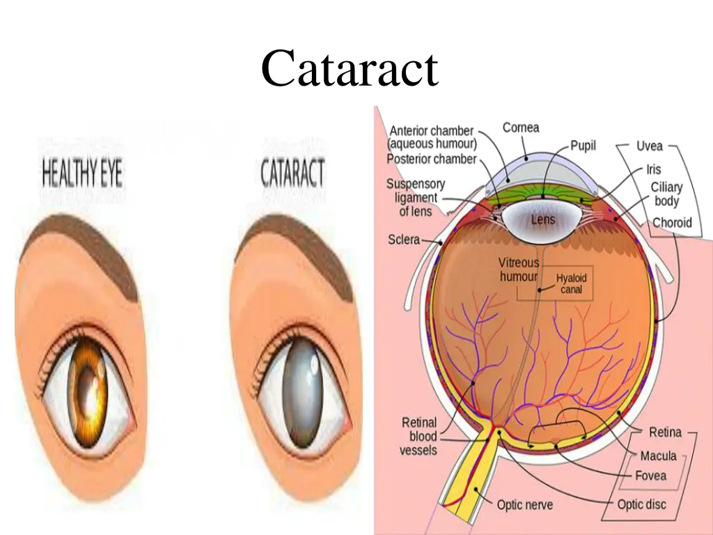 cataract