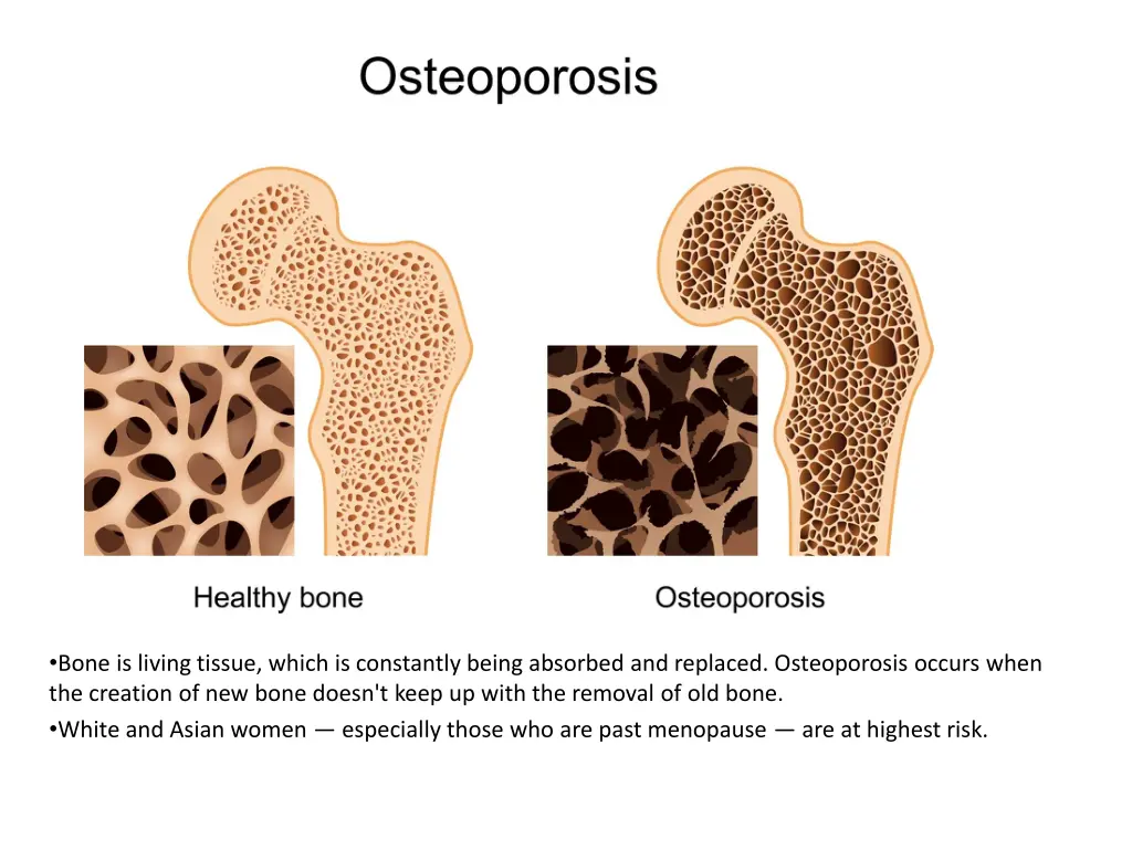 bone is living tissue which is constantly being