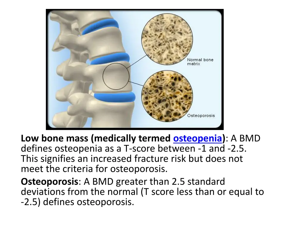low bone mass medically termed osteopenia
