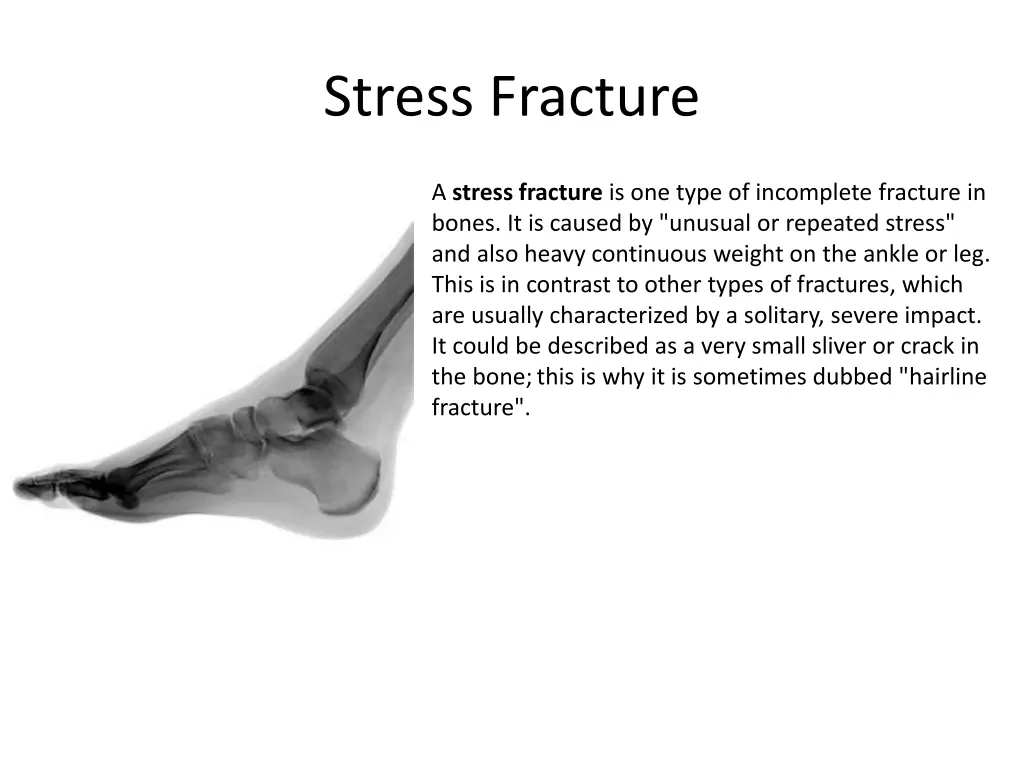 stress fracture