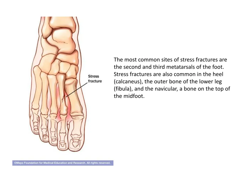 the most common sites of stress fractures