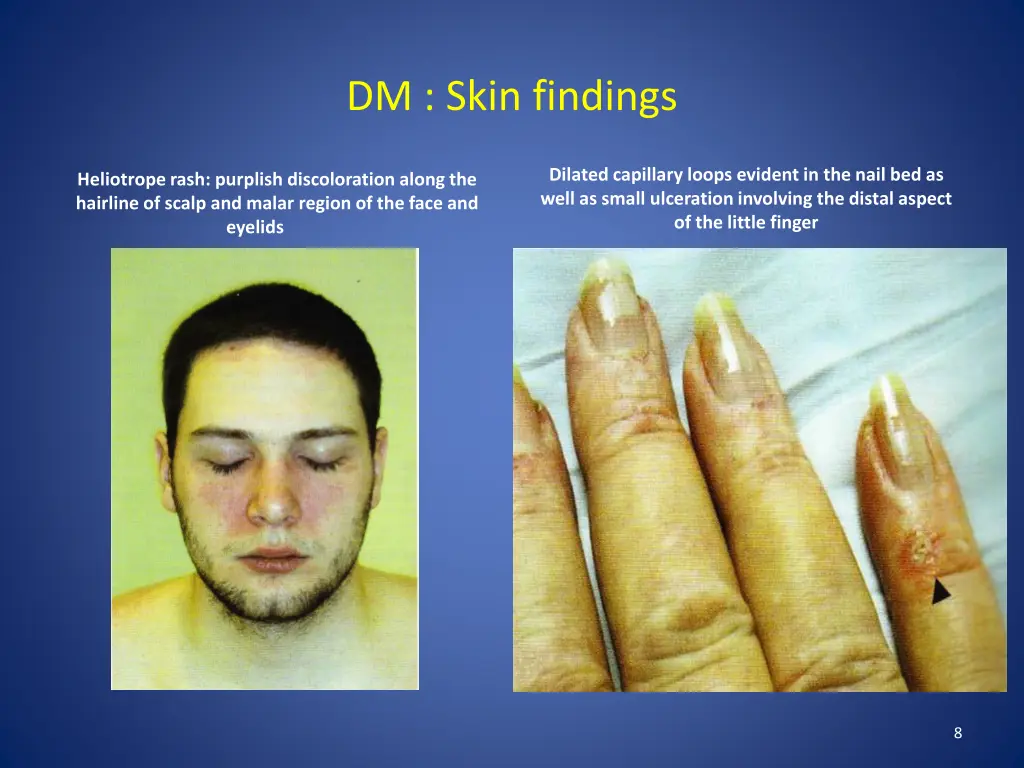 dm skin findings