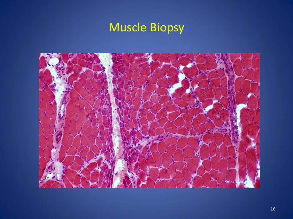 muscle biopsy 1