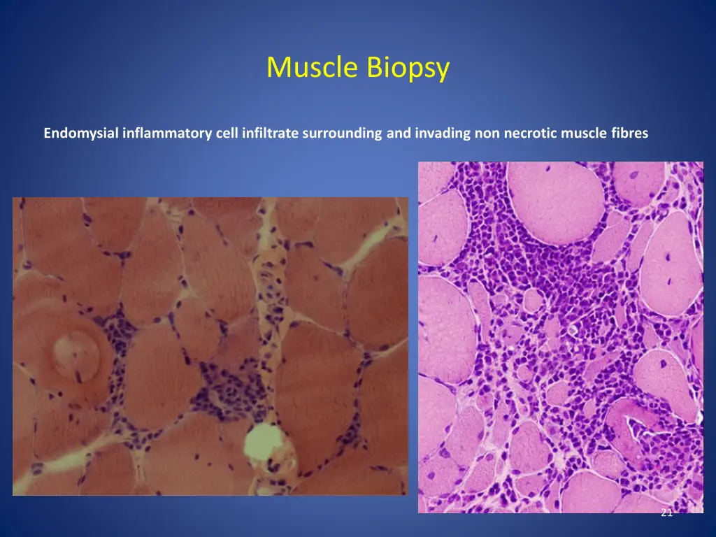 muscle biopsy 2