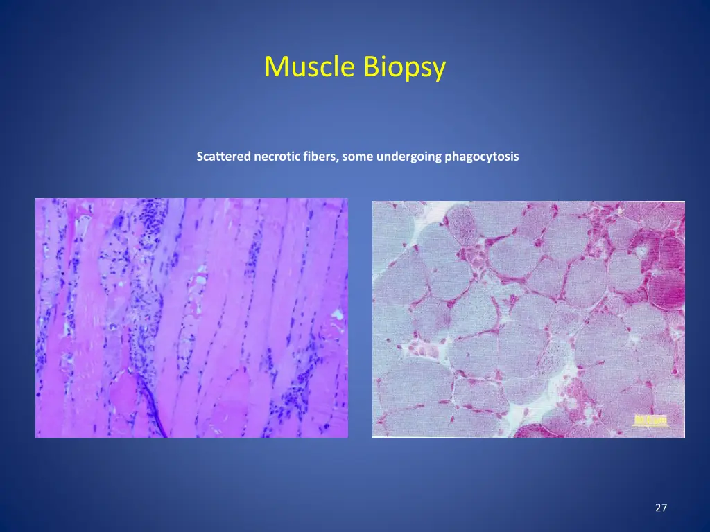 muscle biopsy 3