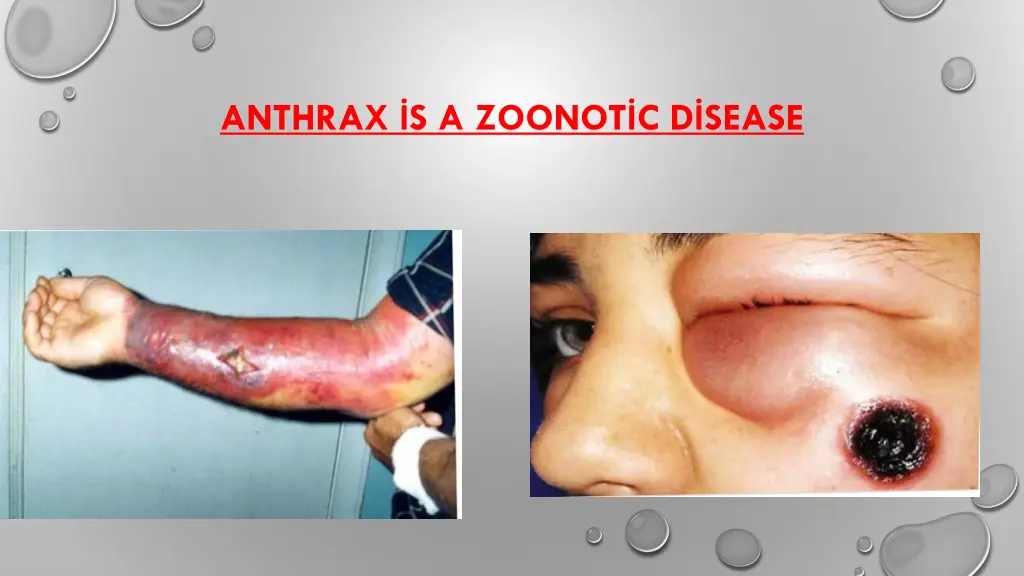 anthrax s a zoonot c d sease