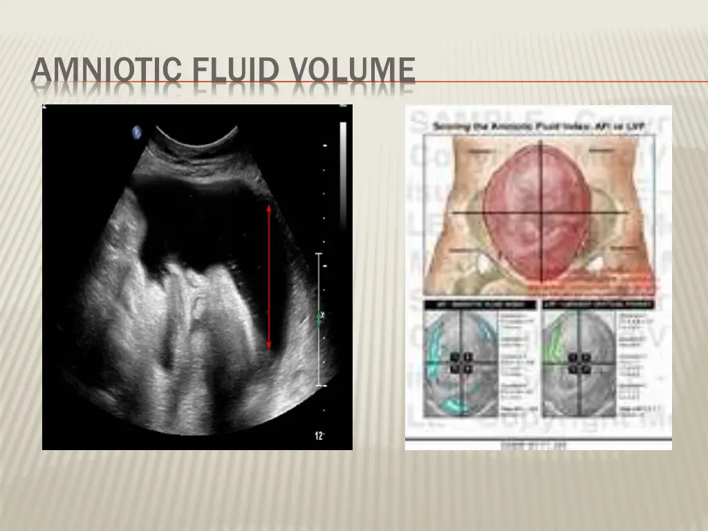 amniotic fluid volume