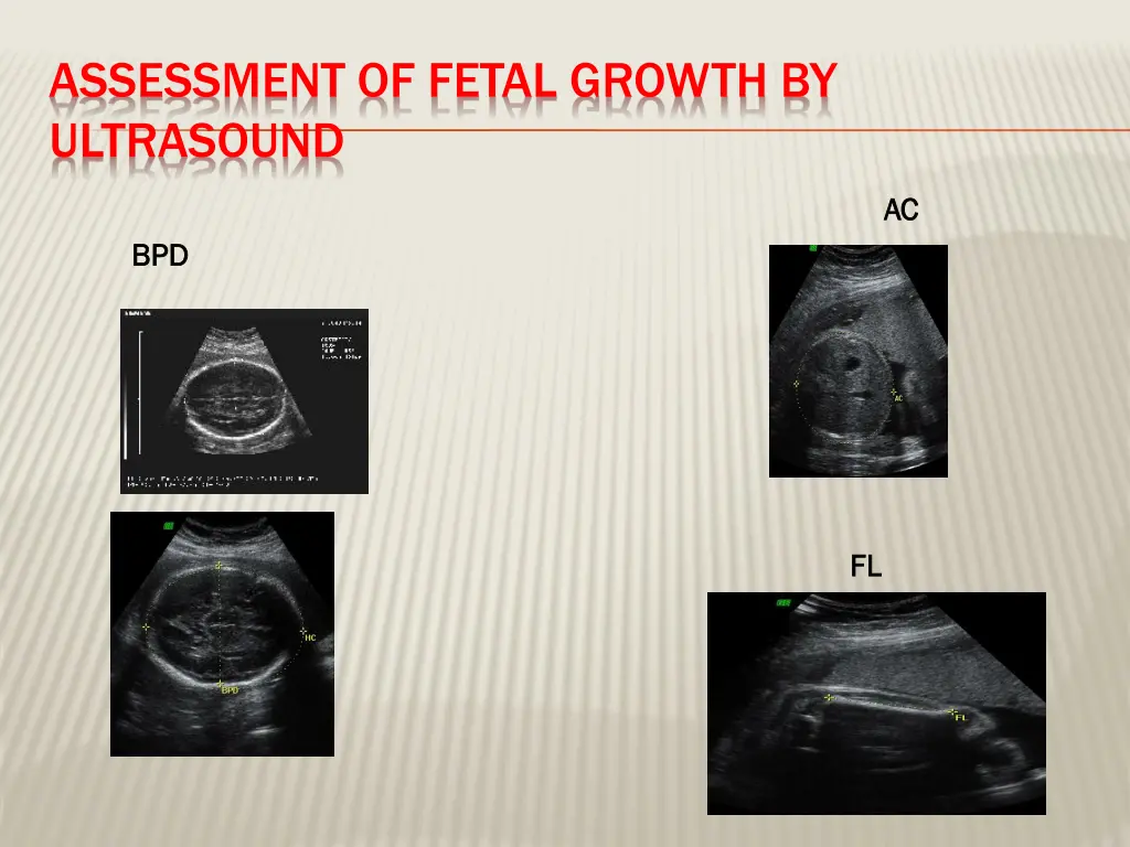 assessment of fetal growth by ultrasound