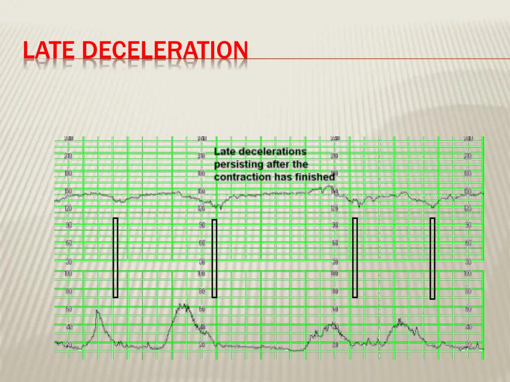late deceleration