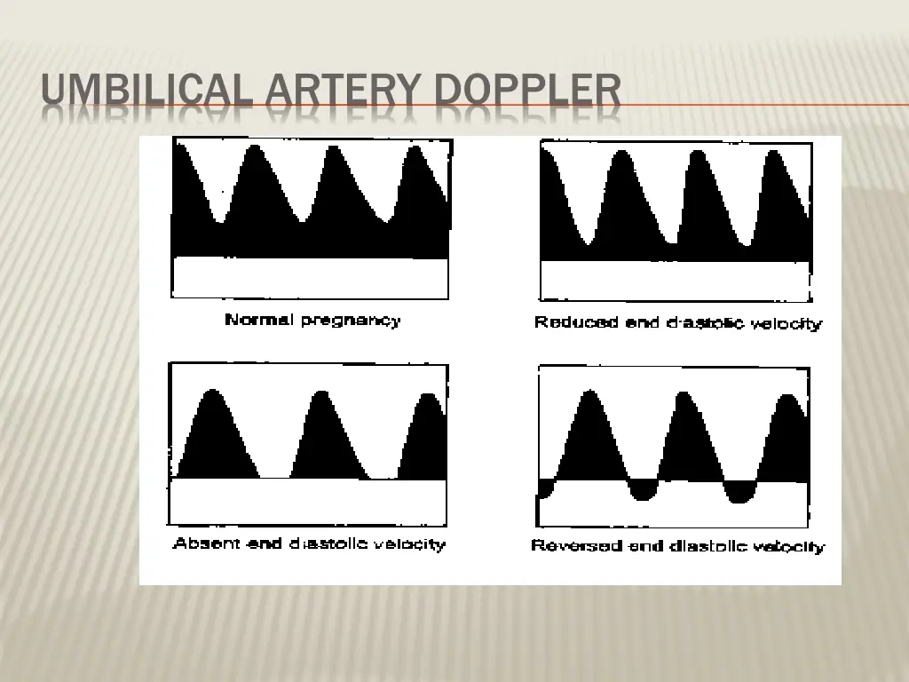 umbilical artery doppler