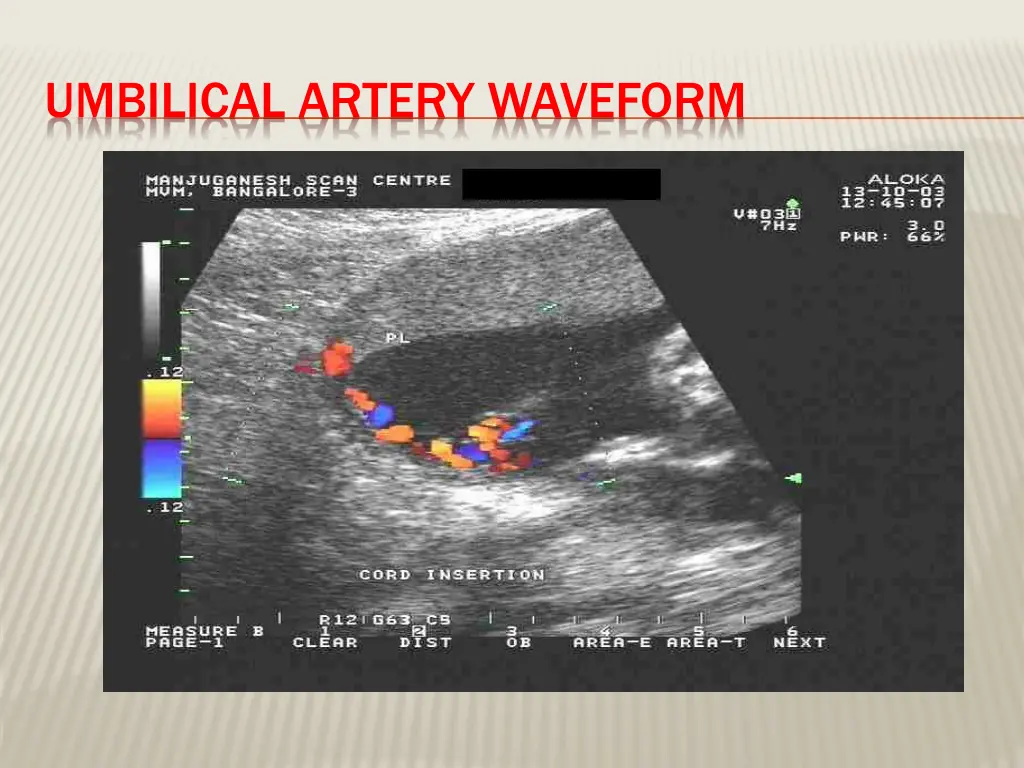 umbilical artery waveform