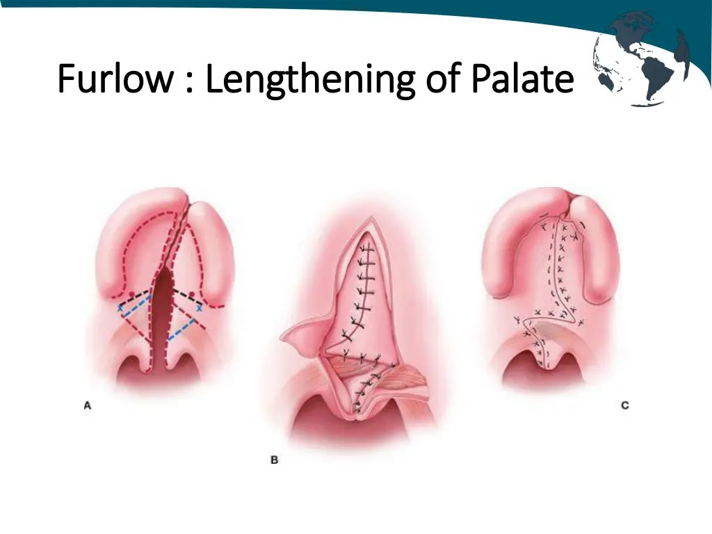 furlow furlow lengthening of palate lengthening