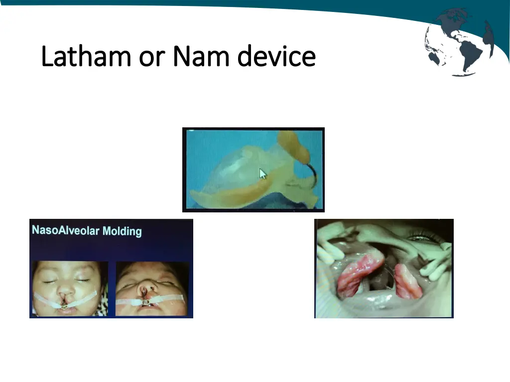 latham or nam device latham or nam device