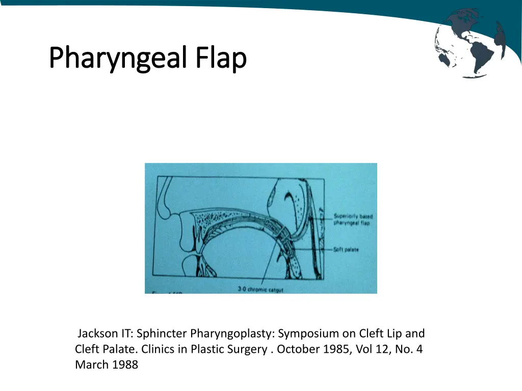 pharyngeal pharyngeal flap