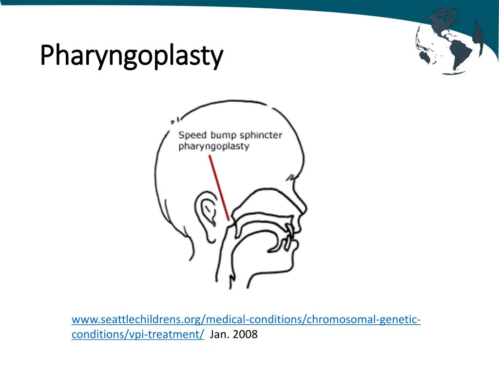 pharyngoplasty pharyngoplasty