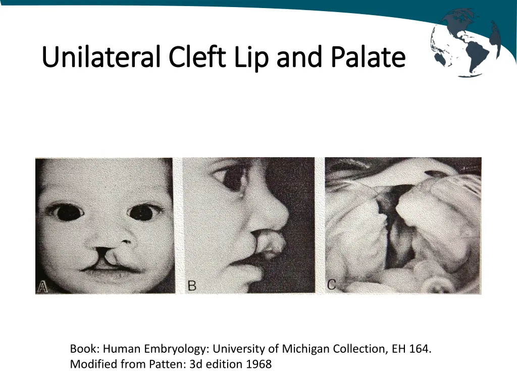 unilateral unilateral cleft