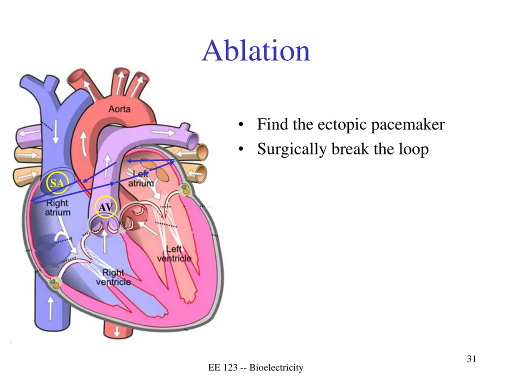ablation