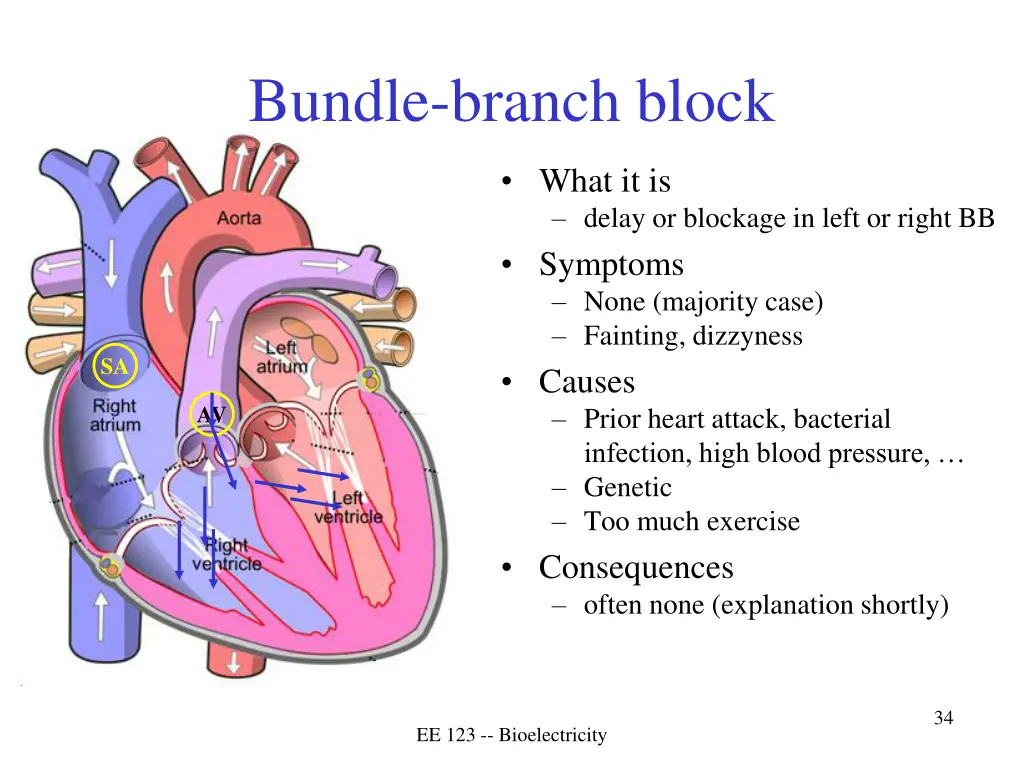 bundle branch block