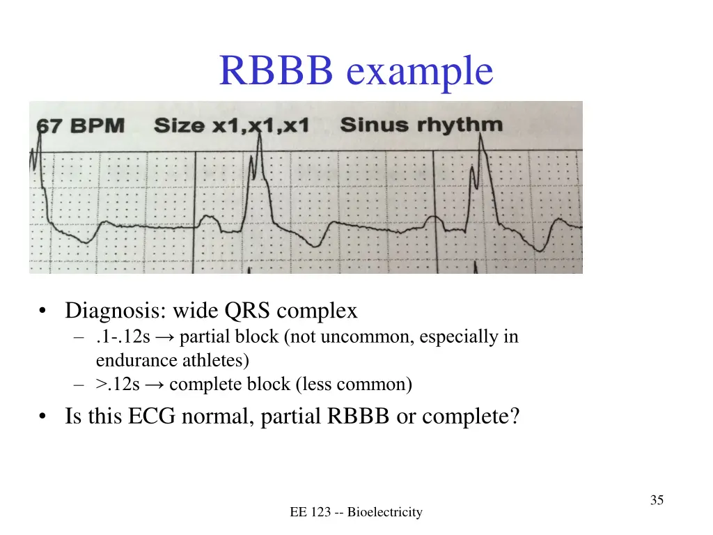 rbbb example