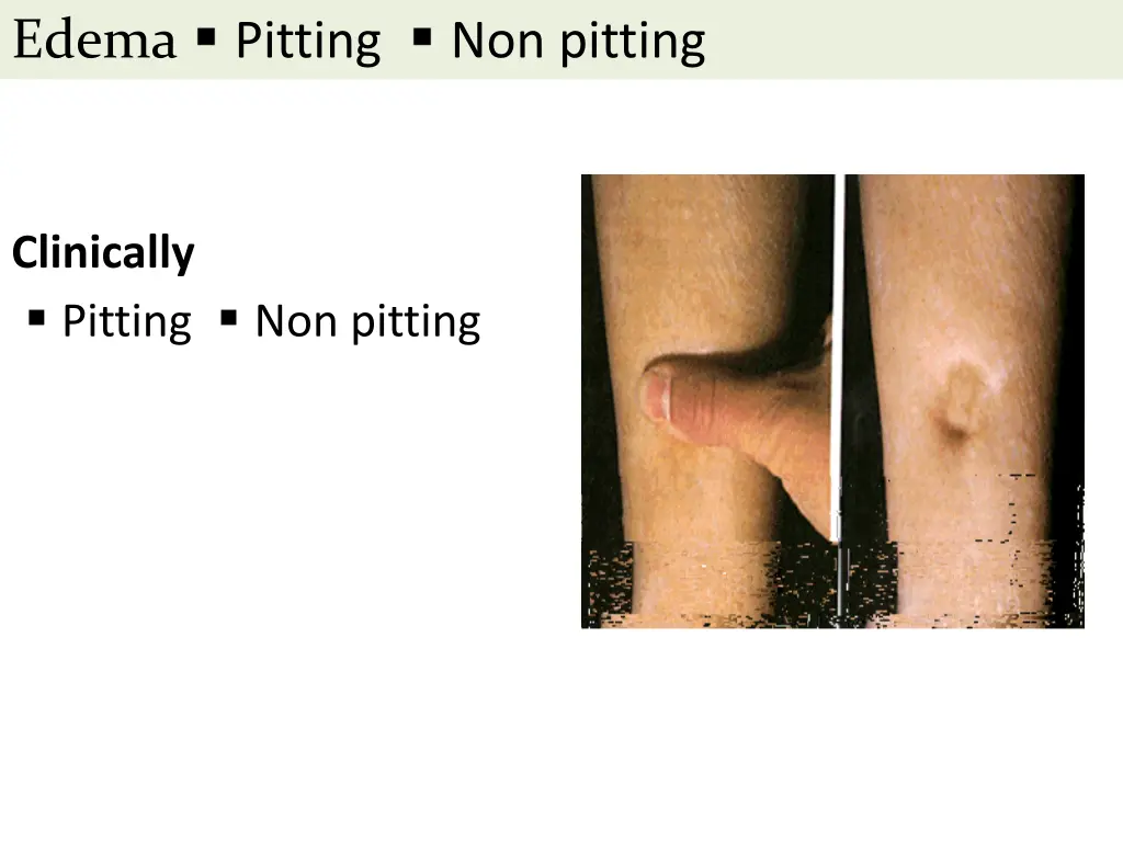edema 1