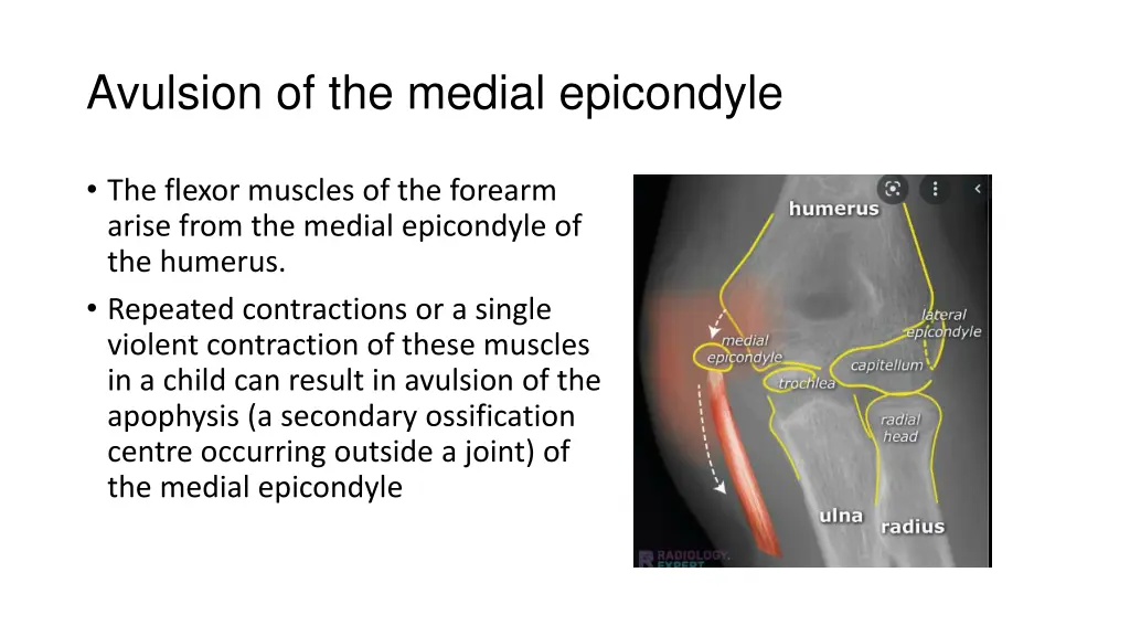 avulsion of the medial epicondyle