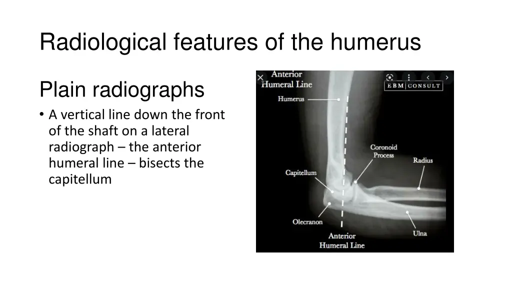 radiological features of the humerus