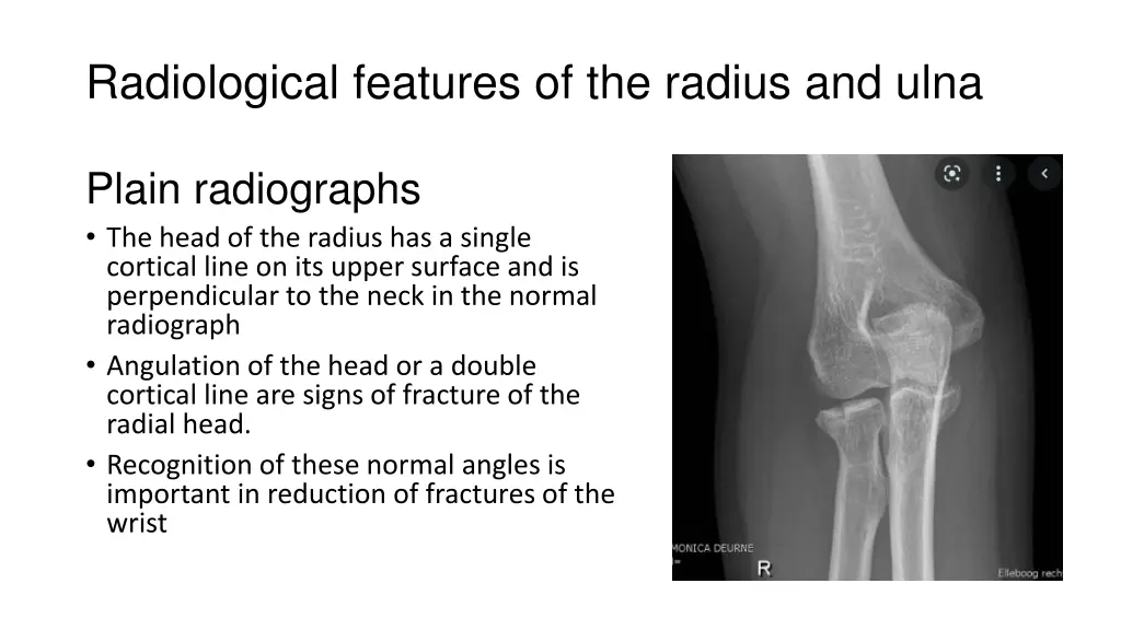 radiological features of the radius and ulna