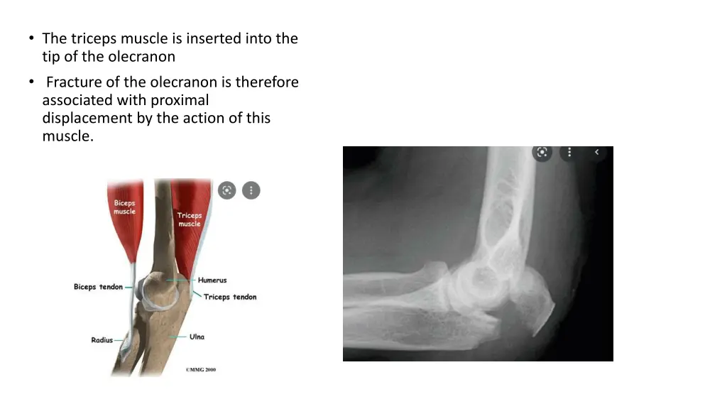 the triceps muscle is inserted into
