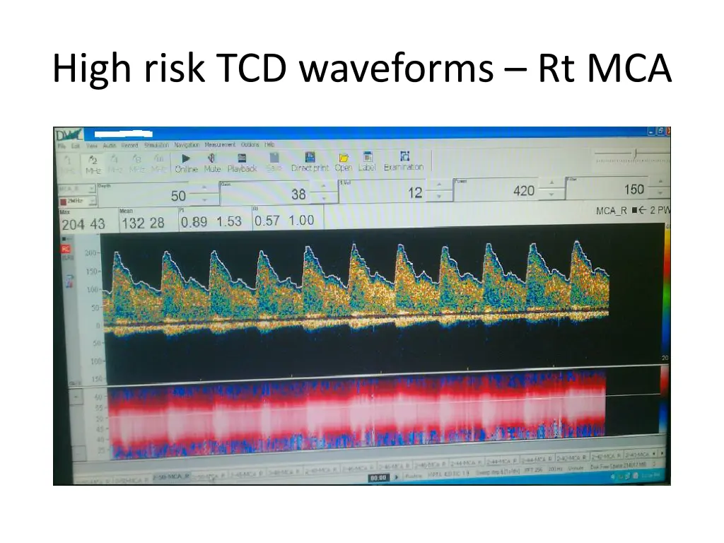 high risk tcd waveforms rt mca