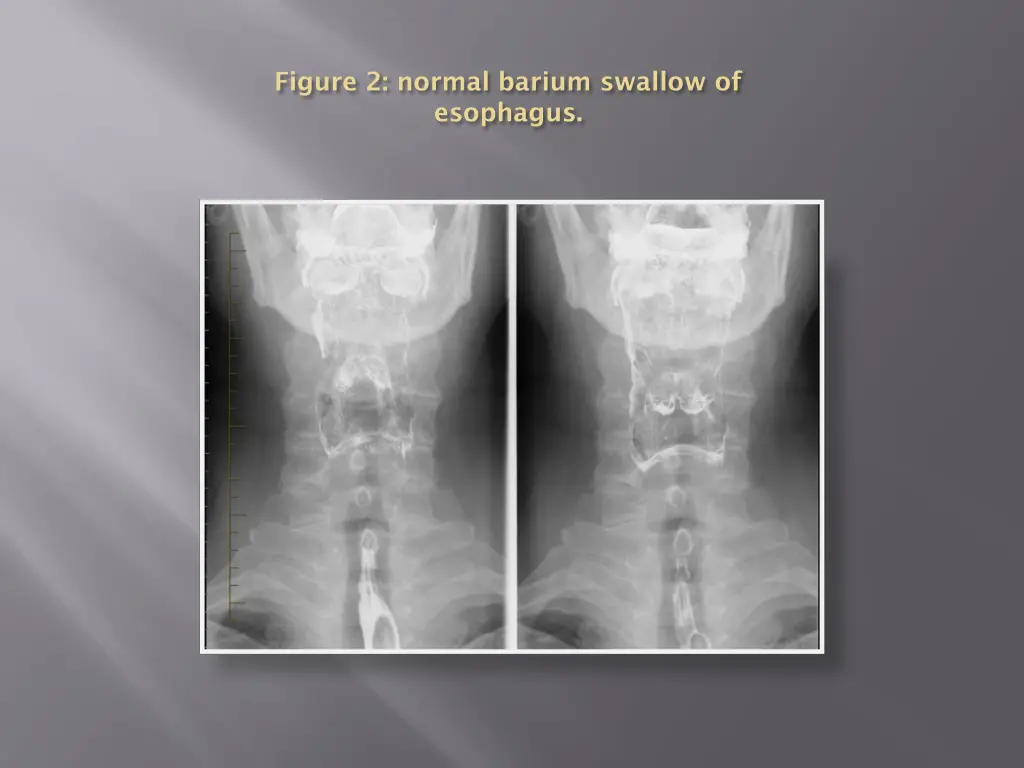 figure 2 normal barium swallow of esophagus