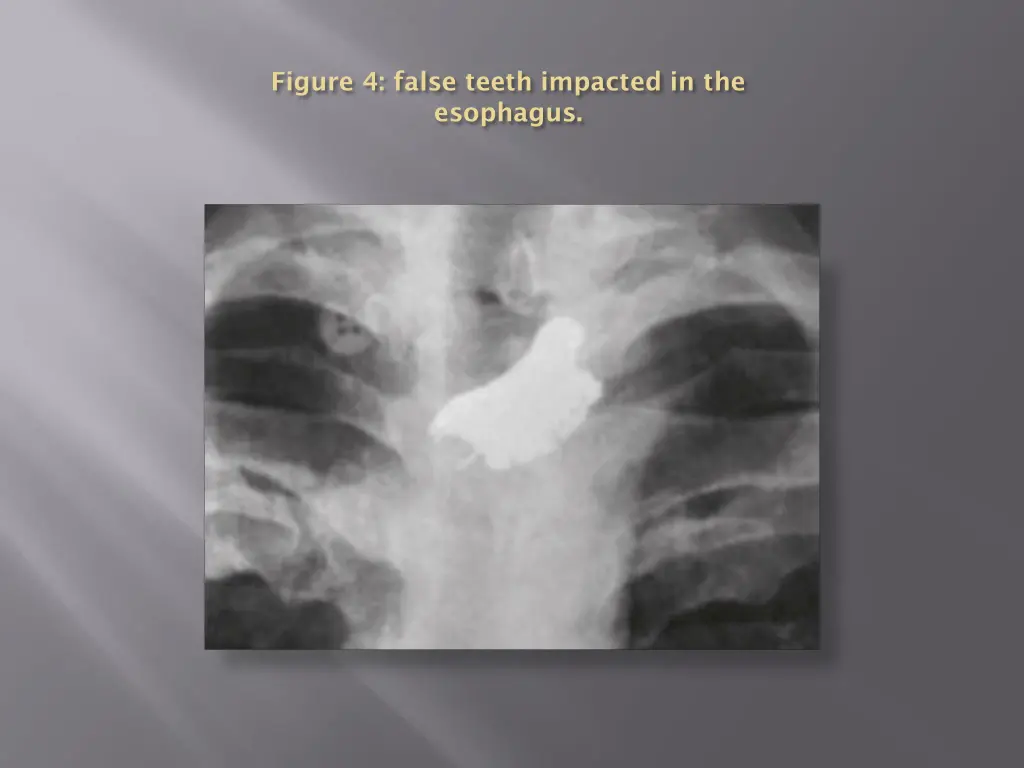 figure 4 false teeth impacted in the esophagus