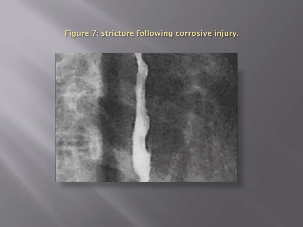 figure 7 stricture following corrosive injury