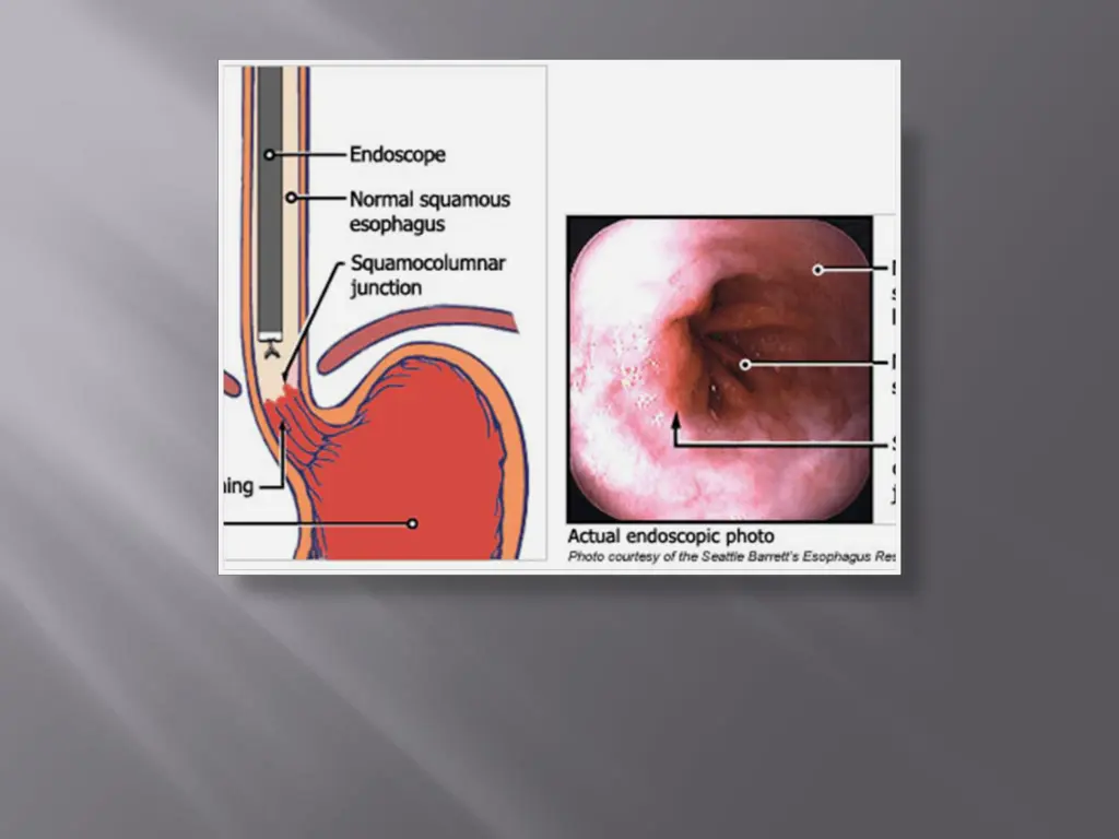 figure3 ogd of esophagus and cardia