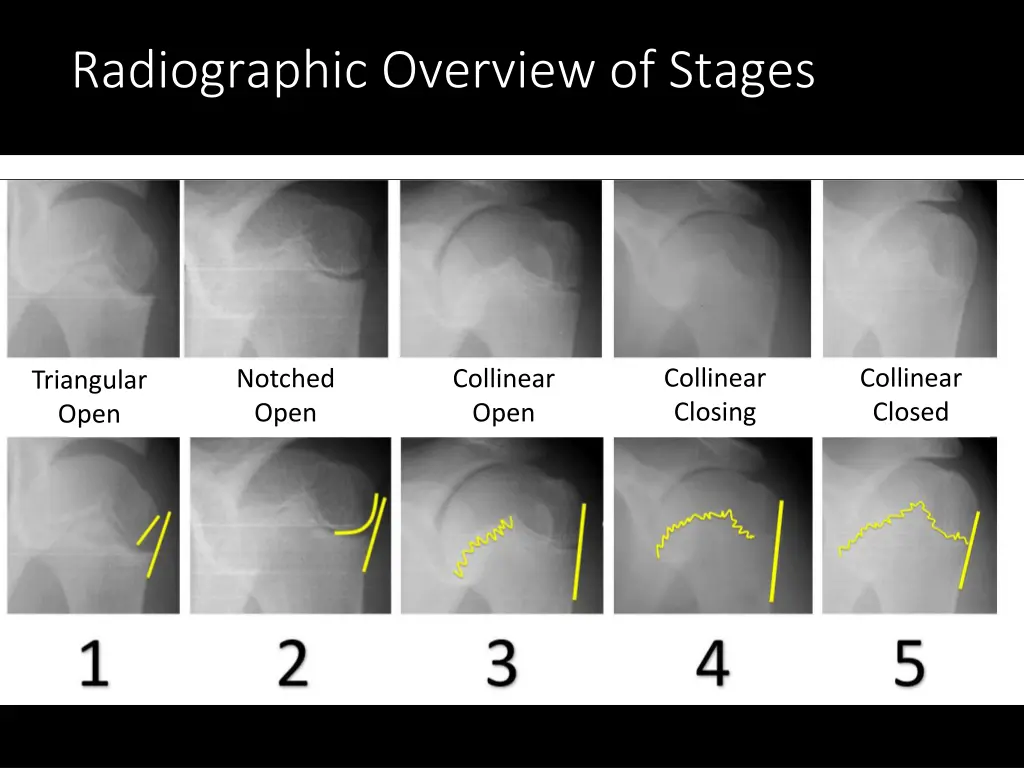 radiographic overview of stages