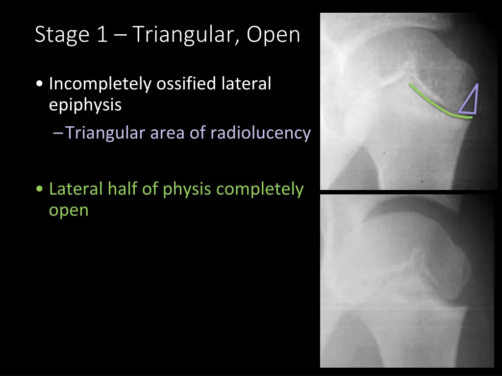 stage 1 triangular open